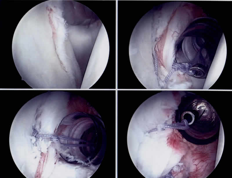 Bildserie einer arthroskopisch durchgeführten Schulterstabilisierung